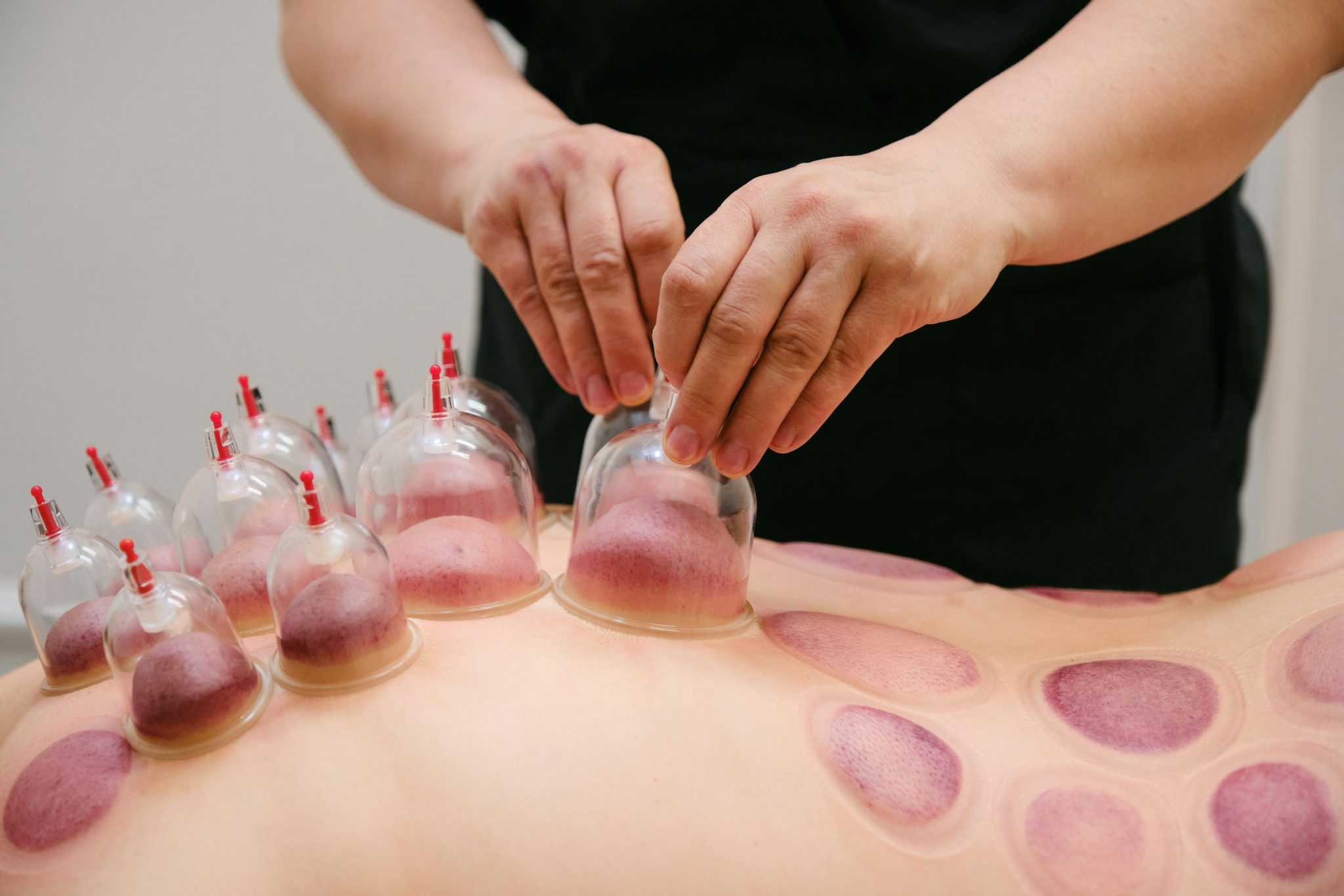 Cupping Therapy Near Me: What to Expect, What It Costs, and Whether It's Worth It